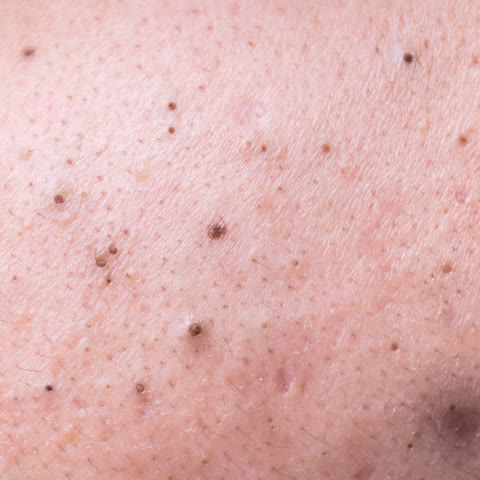 สิวหัวเปิด: สิวหัวดำที่มีลักษณะเป็นสิวหัวเปิด หรือสิวเสี้ยน